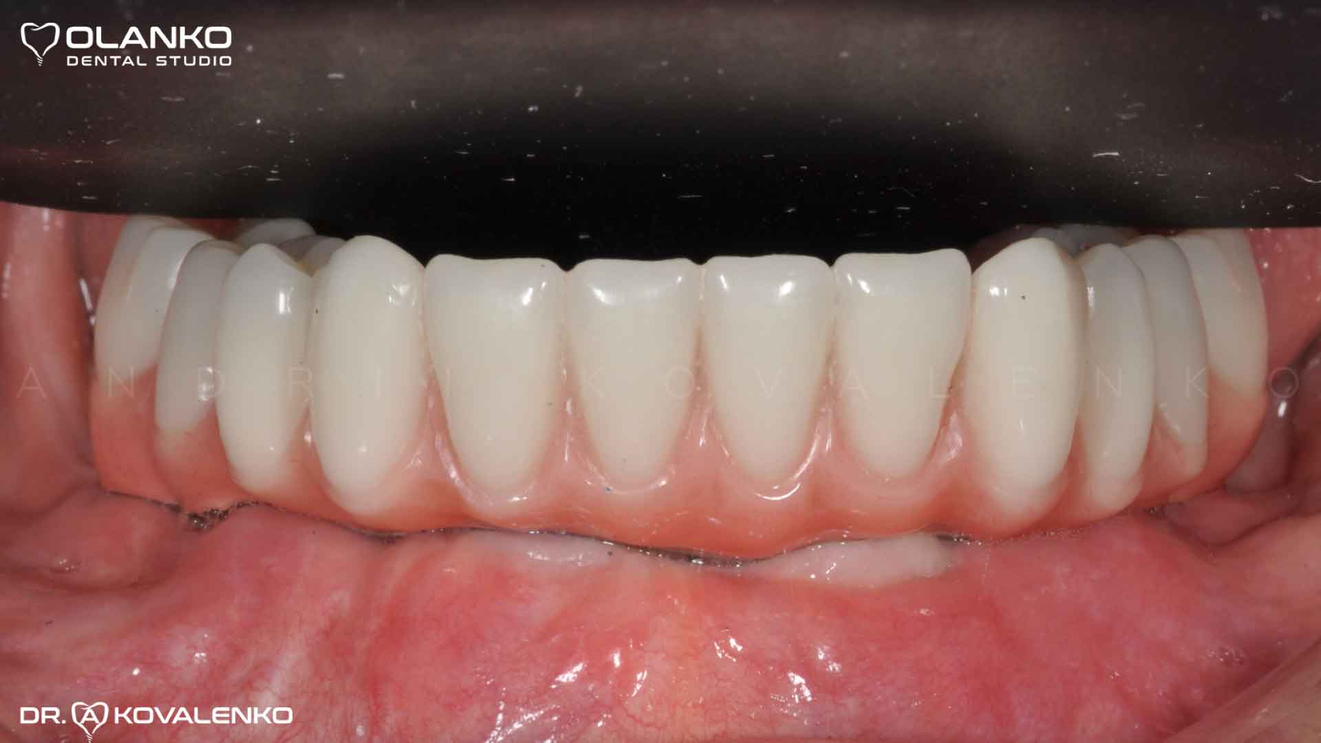 Клинический случай 9 имплантация зубов